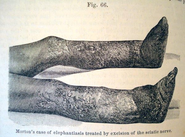 elephantiasis of the leg